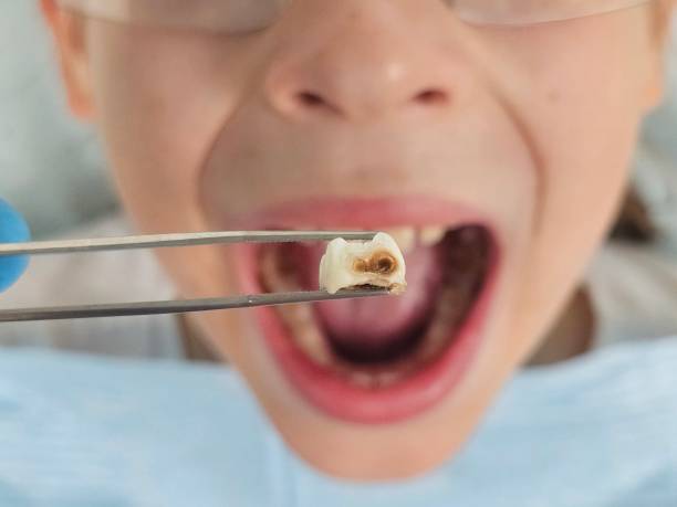 Best Emergency Tooth Extraction in Elizabethtown, PA